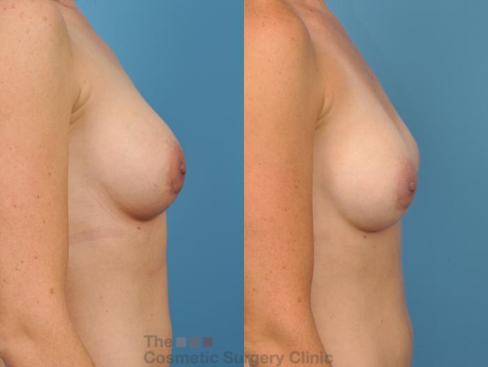 Before & After Breast Augmentation Case 49 View #8 View in Waterloo, Ontario