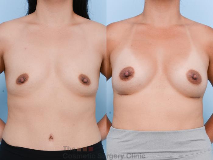 Before & After Breast Augmentation Case 606 View #1 View in Waterloo, Ontario