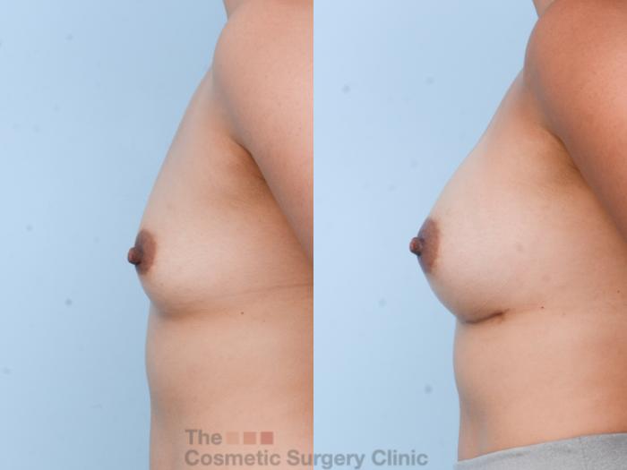 Before & After Breast Augmentation Case 606 View #2 View in Waterloo, Ontario