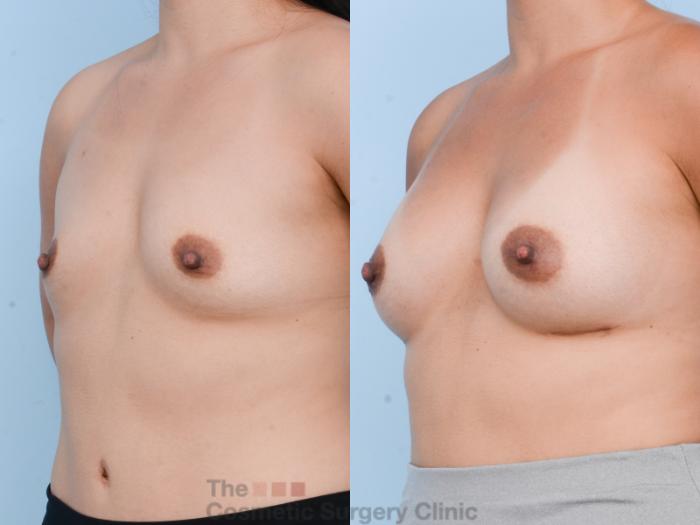 Before & After Breast Augmentation Case 606 View #3 View in Waterloo, Ontario