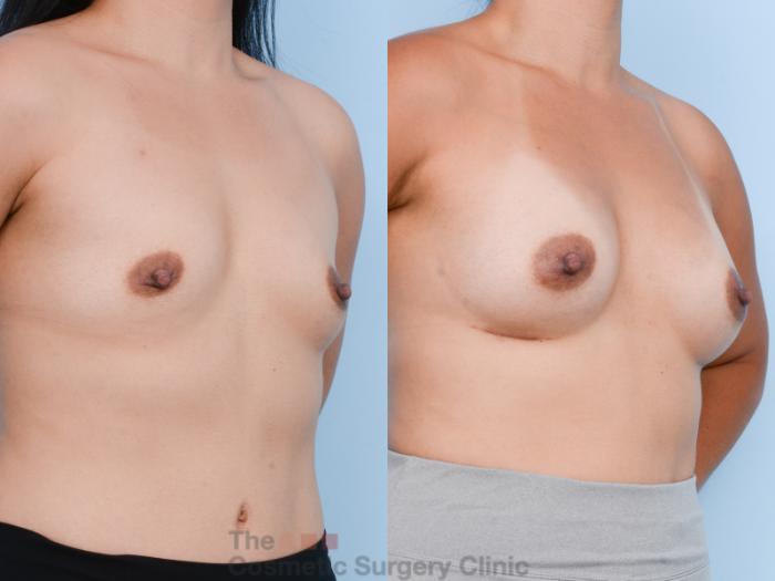 Before & After Breast Augmentation Case 606 View #4 View in Waterloo, Ontario