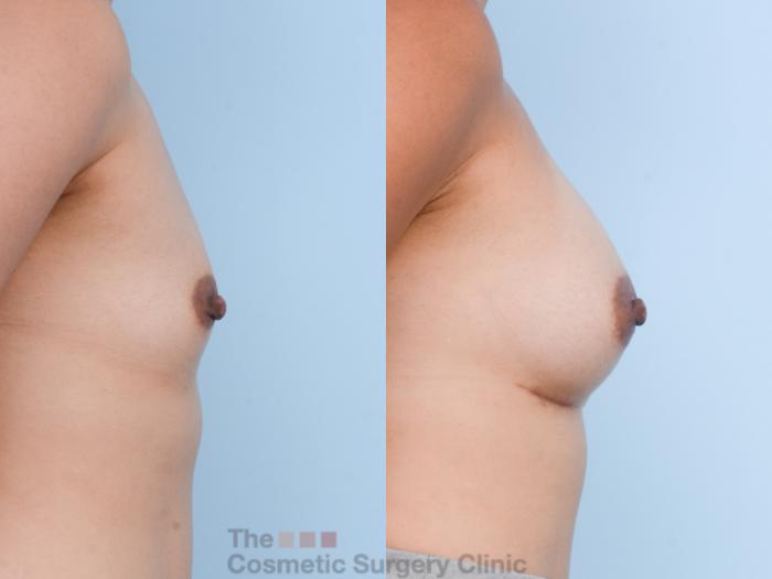 Before & After Breast Augmentation Case 606 View #5 View in Waterloo, Ontario