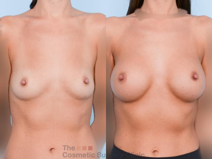 Before & After Breast Augmentation Case 764 Front View in Waterloo, Ontario