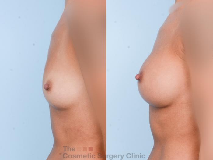 Before & After Breast Augmentation Case 764 Left Side View in Waterloo, Ontario