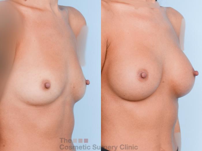 Before & After Breast Augmentation Case 764 Right Oblique View in Waterloo, Ontario