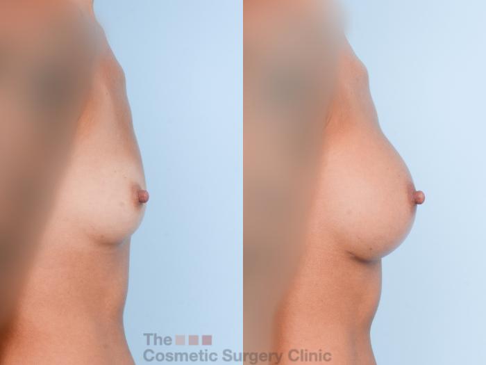 Before & After Breast Augmentation Case 764 Right Side View in Waterloo, Ontario