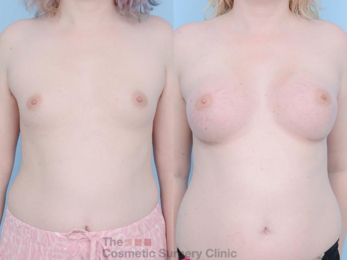 Before & After Breast Augmentation Case 788 Front View in Waterloo, Ontario