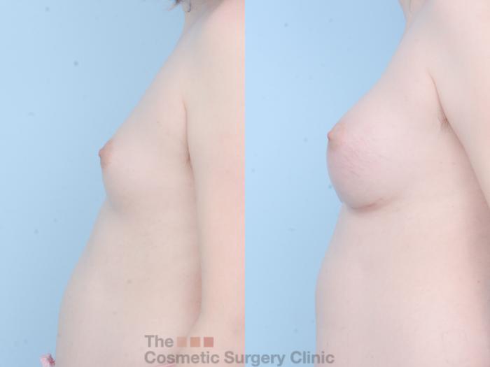 Before & After Breast Augmentation Case 788 Left Side View in Waterloo, Ontario