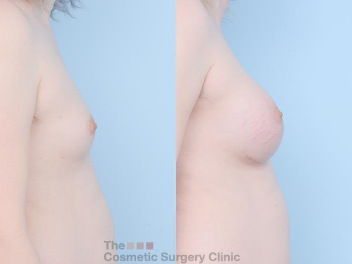 Before & After Breast Augmentation Case 788 Right Side View in Waterloo, Ontario