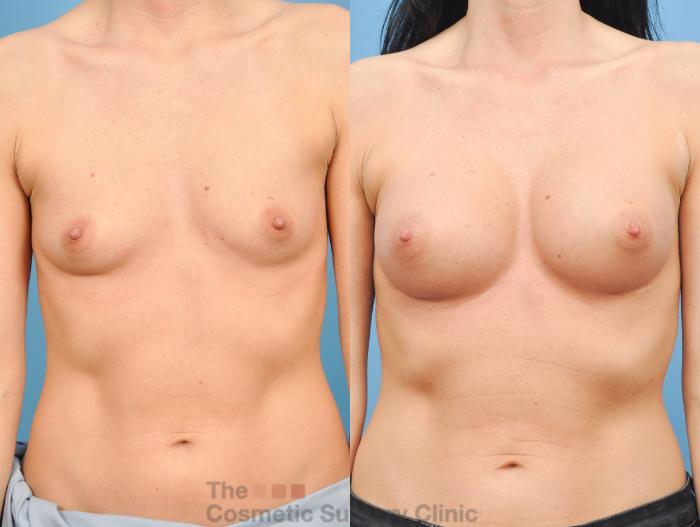 Before & After Breast Augmentation Case 810 Front View in Waterloo, Ontario
