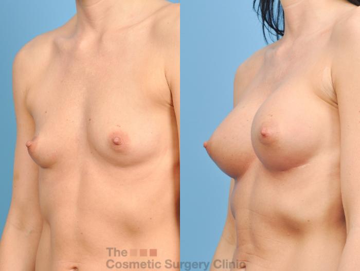 Before & After Breast Augmentation Case 810 Left Oblique View in Waterloo, Ontario
