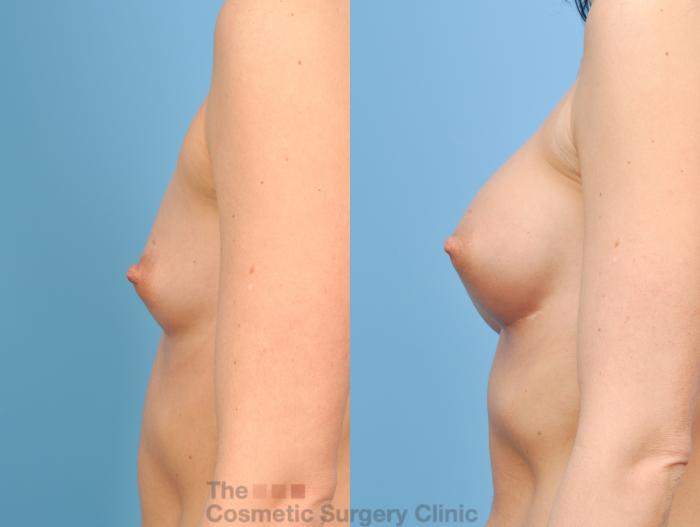 Before & After Breast Augmentation Case 810 Left Side View in Waterloo, Ontario