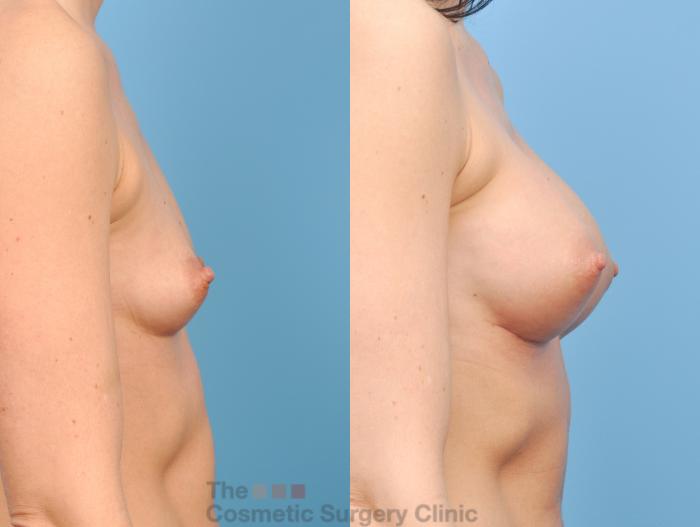 Before & After Breast Augmentation Case 810 Right Side View in Waterloo, Ontario