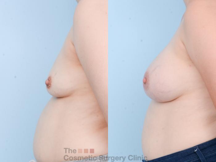 Before & After Breast Augmentation Case 815 Left Side View in Waterloo, Ontario