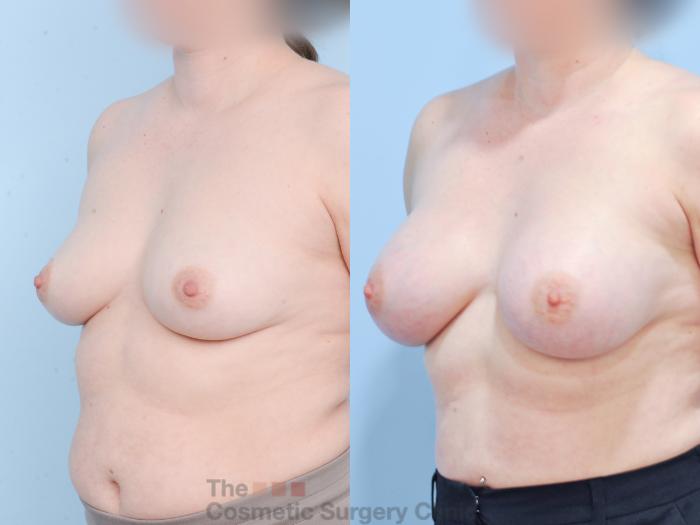 Before & After Breast Augmentation Case 820 Left Oblique View in Waterloo, Ontario