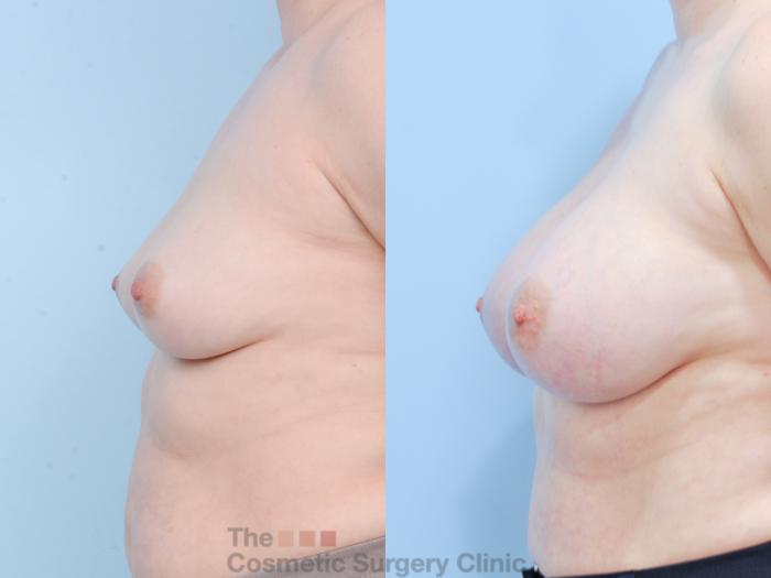 Before & After Breast Augmentation Case 820 Left Side View in Waterloo, Ontario