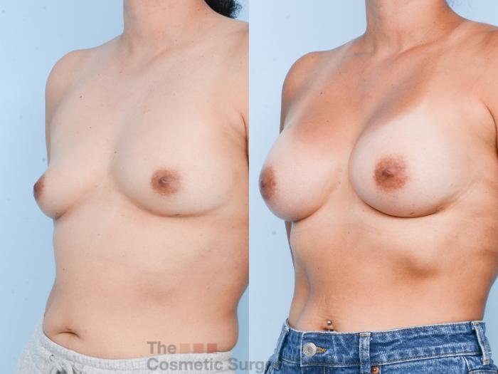 Before & After Breast Augmentation Case 821 Left Oblique View in Waterloo, Ontario