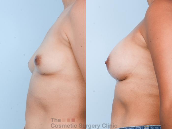 Before & After Breast Augmentation Case 821 Left Side View in Waterloo, Ontario