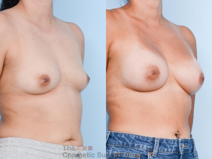 Before & After Breast Augmentation Case 821 Right Oblique View in Waterloo, Ontario