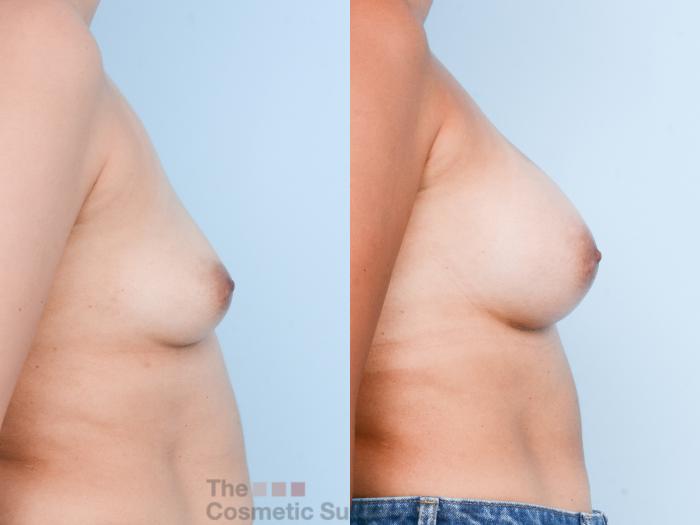 Before & After Breast Augmentation Case 821 Right Side View in Waterloo, Ontario