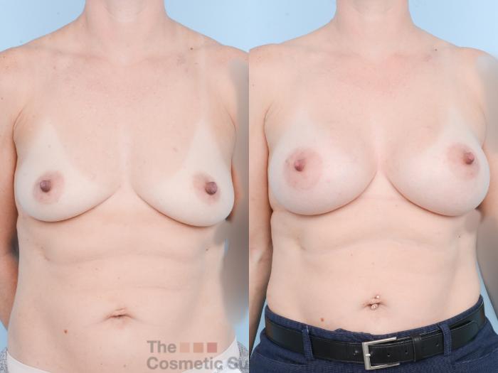 Before & After Breast Augmentation Case 823 Front View in Waterloo, Ontario