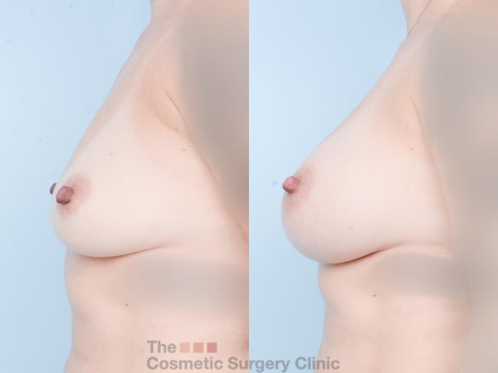 Before & After Breast Augmentation Case 823 Left Side View in Waterloo, Ontario