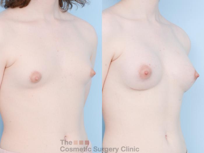 Before & After Breast Augmentation Case 834 Right Oblique View in Waterloo, Ontario