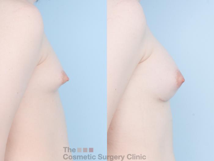 Before & After Breast Augmentation Case 834 Right Side View in Waterloo, Ontario