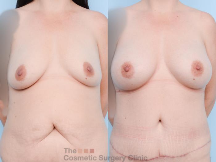 Before & After Breast Augmentation Case 858 Front View in Waterloo, Ontario