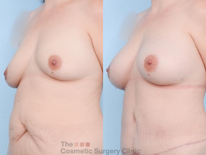Before & After Breast Augmentation Case 858 Left Oblique View in Waterloo, Ontario