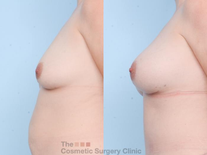Before & After Breast Augmentation Case 858 Left Side View in Waterloo, Ontario