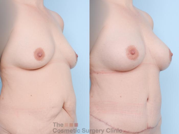 Before & After Breast Augmentation Case 858 Right Oblique View in Waterloo, Ontario