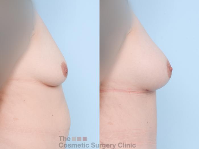 Before & After Breast Augmentation Case 858 Right Side View in Waterloo, Ontario