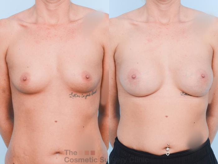 Before & After Breast Augmentation Case 866 Front View in Waterloo, Ontario