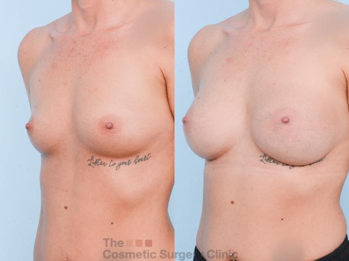Before & After Breast Augmentation Case 866 Left Oblique View in Waterloo, Ontario