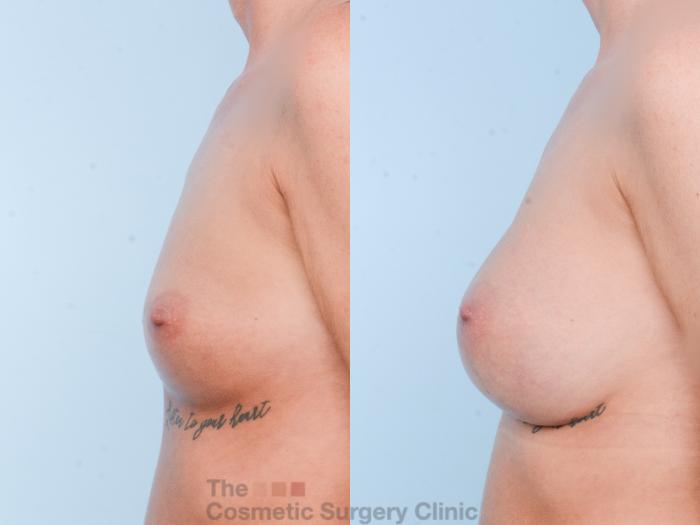Before & After Breast Augmentation Case 866 Left Side View in Waterloo, Ontario