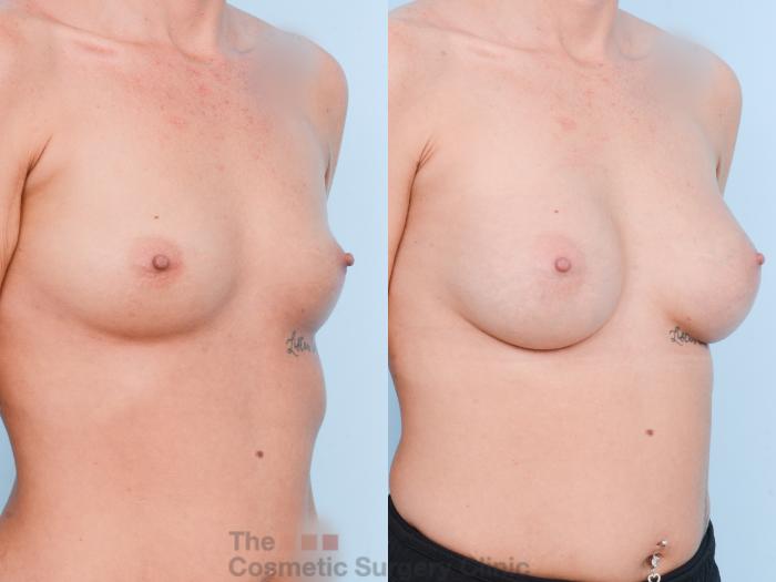 Before & After Breast Augmentation Case 866 Right Oblique View in Waterloo, Ontario