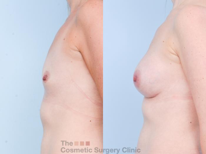 Before & After Breast Augmentation Case 884 Left Side View in Waterloo, Ontario