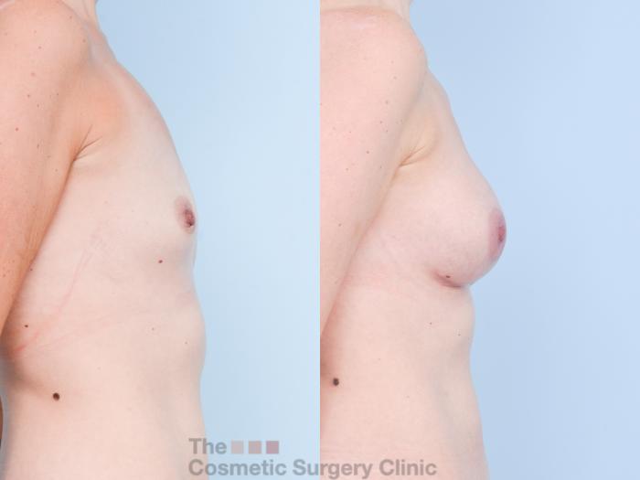 Before & After Breast Augmentation Case 884 Right Side View in Waterloo, Ontario
