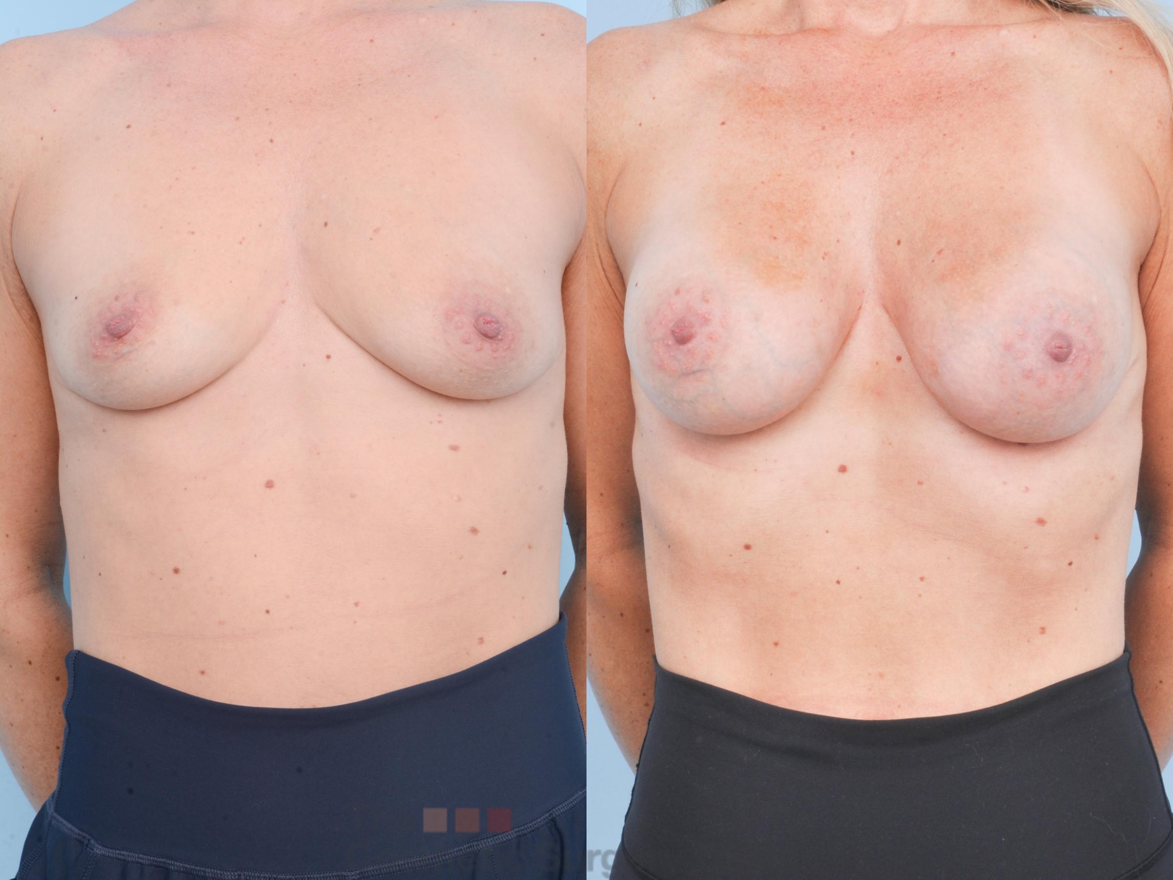 Before & After Breast Augmentation Case 900 Front View in Waterloo, Ontario