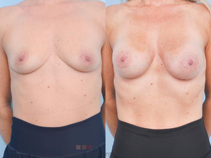 Before & After Breast Augmentation Case 900 Front View in Waterloo, Ontario