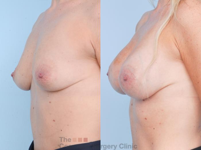Before & After Breast Augmentation Case 900 Left Oblique View in Waterloo, Ontario
