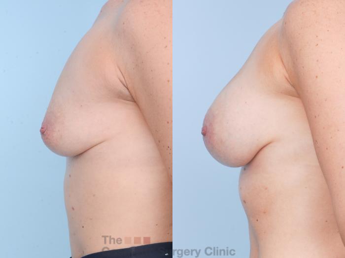 Before & After Breast Augmentation Case 900 Left Side View in Waterloo, Ontario