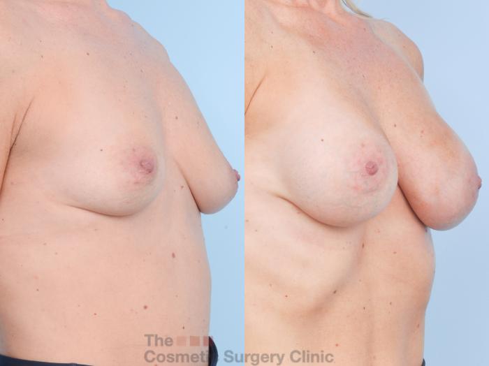 Before & After Breast Augmentation Case 900 Right Oblique View in Waterloo, Ontario