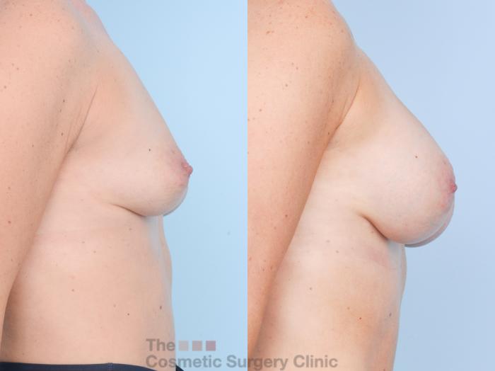 Before & After Breast Augmentation Case 900 Right Side View in Waterloo, Ontario