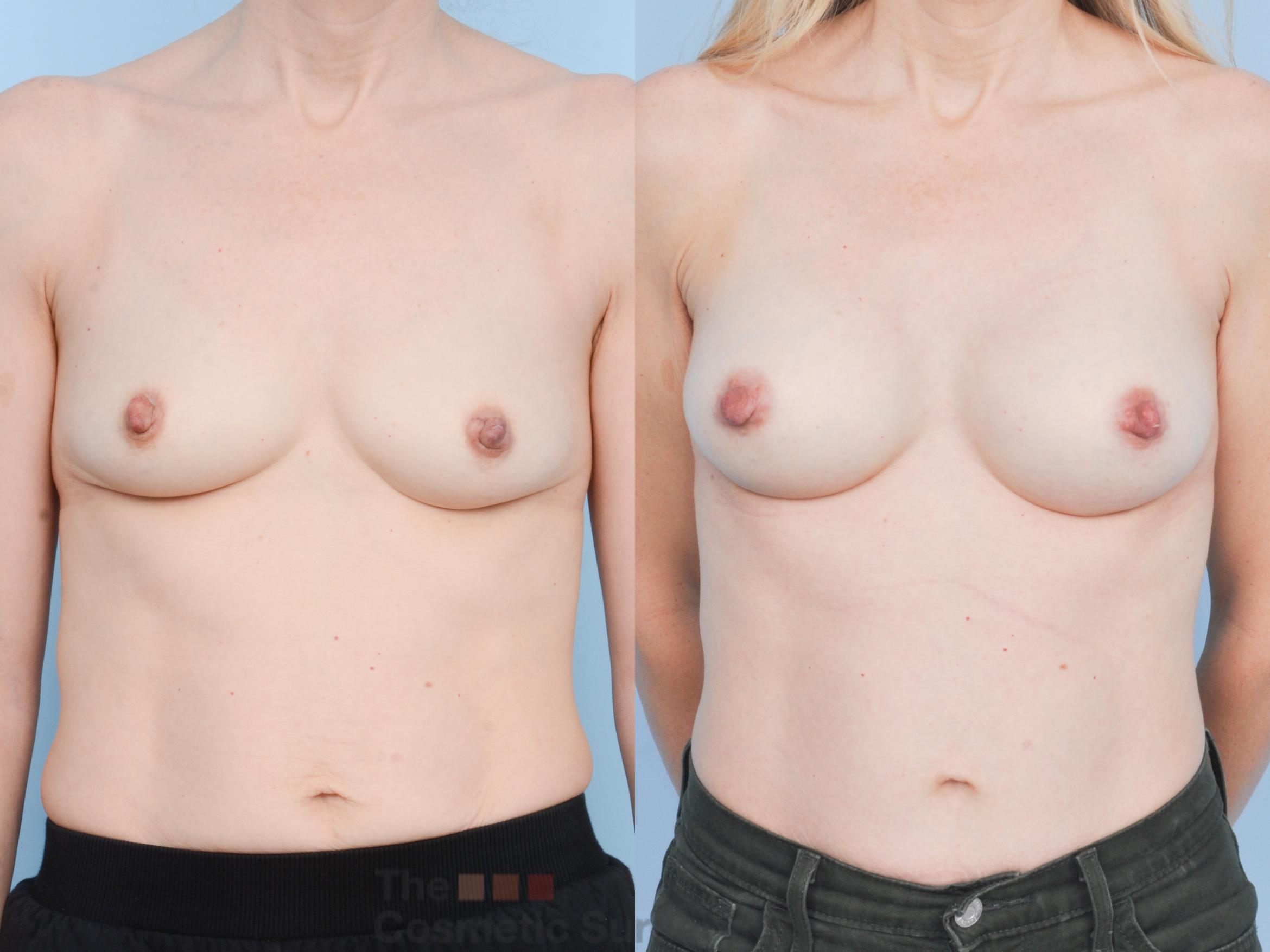 Before & After Breast Augmentation Case 910 Front View in Waterloo, Ontario