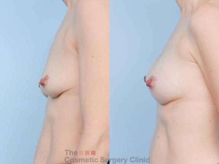 Before & After Breast Augmentation Case 910 Left Side View in Waterloo, Ontario