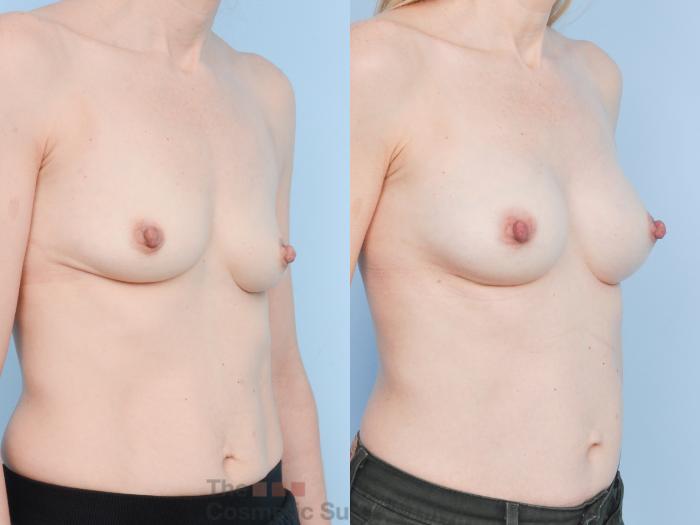 Before & After Breast Augmentation Case 910 Right Oblique View in Waterloo, Ontario