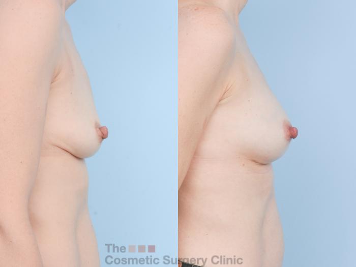 Before & After Breast Augmentation Case 910 Right Side View in Waterloo, Ontario