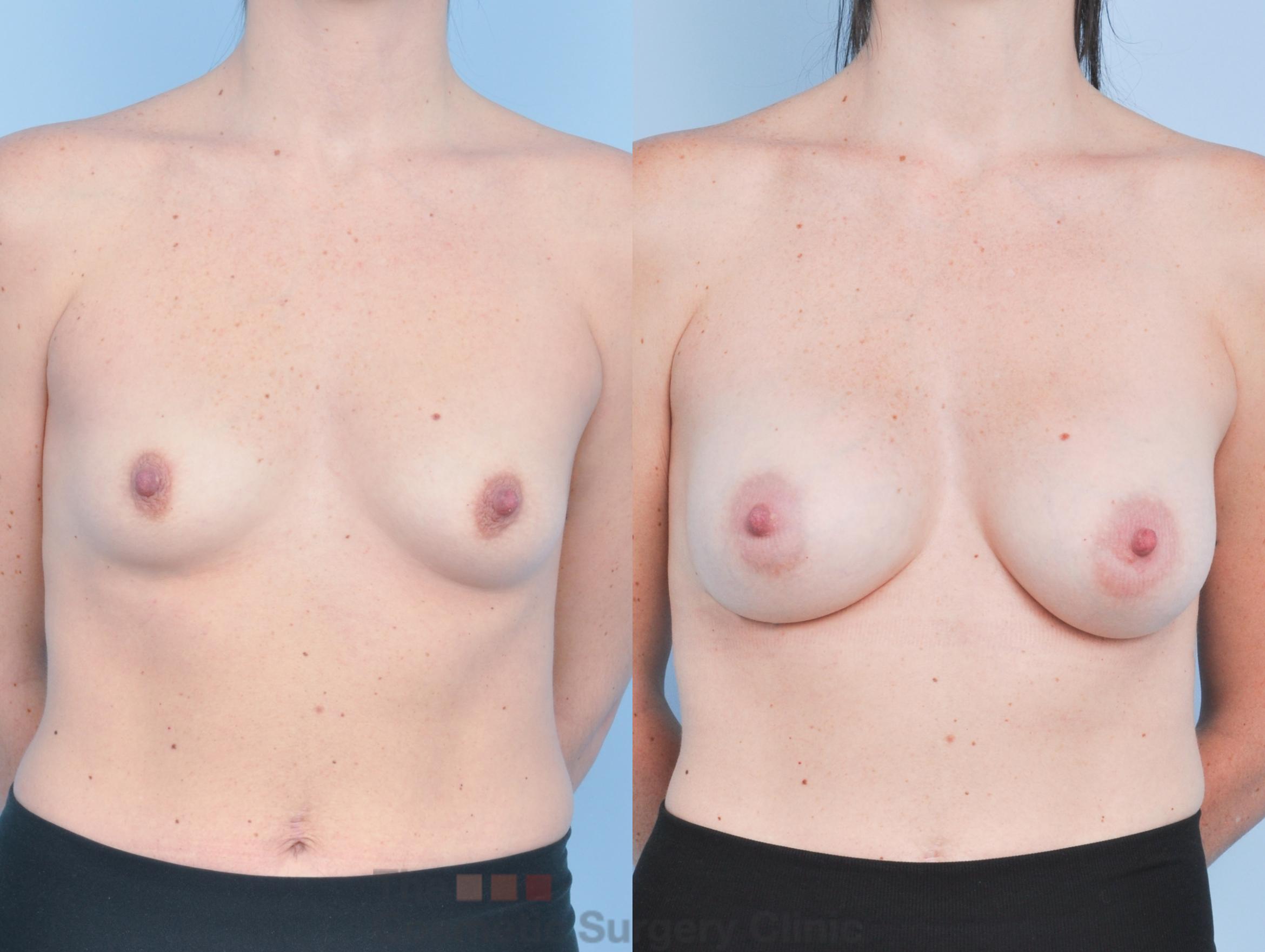 Before & After Breast Augmentation Case 919 Front View in Waterloo, Ontario